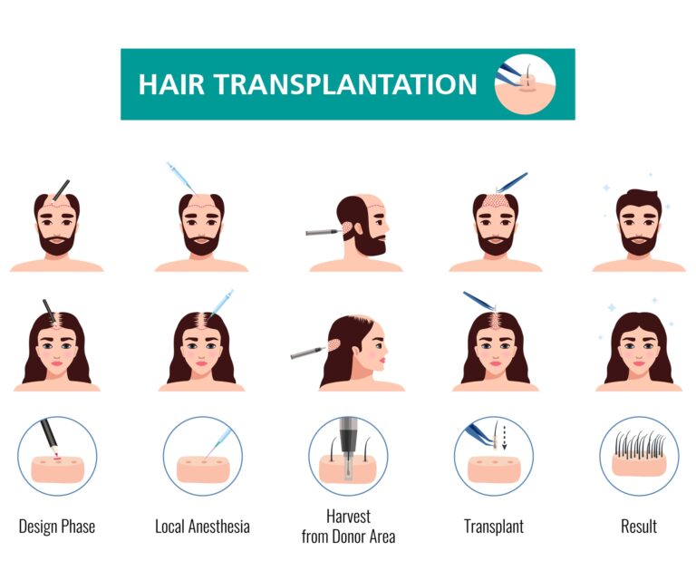 HAIR TRANSPLANT