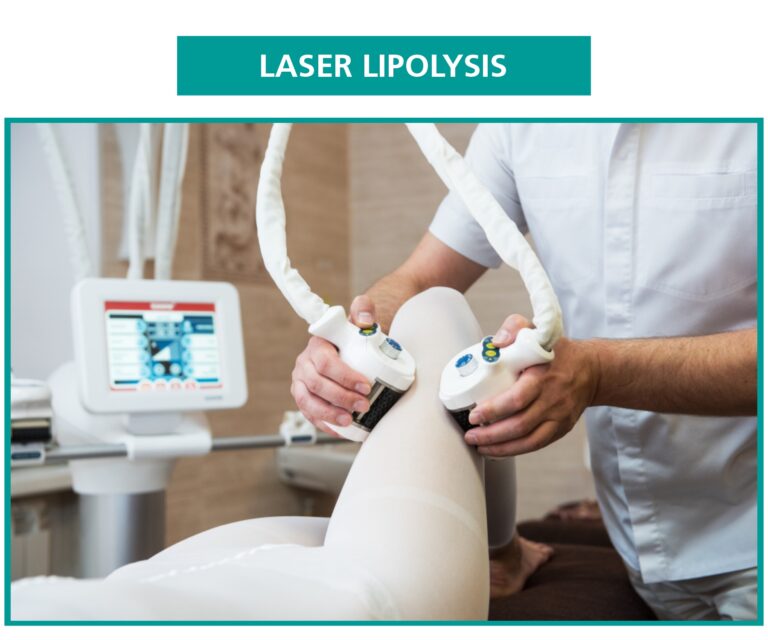 Laser Lipolysis
