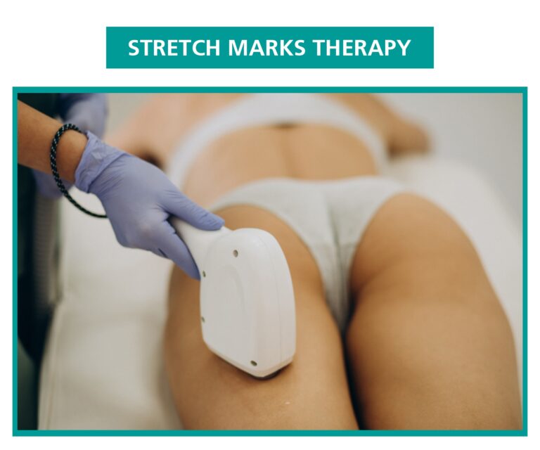 stretch marks reduction